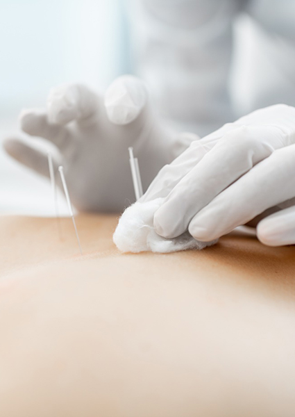 Gloved hand inserting acupuncture needles into patient’s back